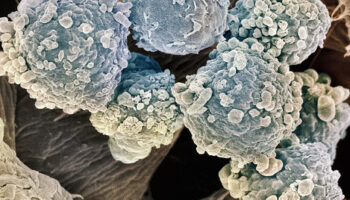 la-leucemia-mielomonocitica-cronica-di-cui-soffriva-berlusconi 