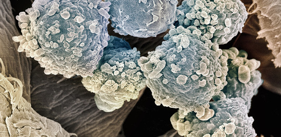 la-leucemia-mielomonocitica-cronica-di-cui-soffriva-berlusconi 